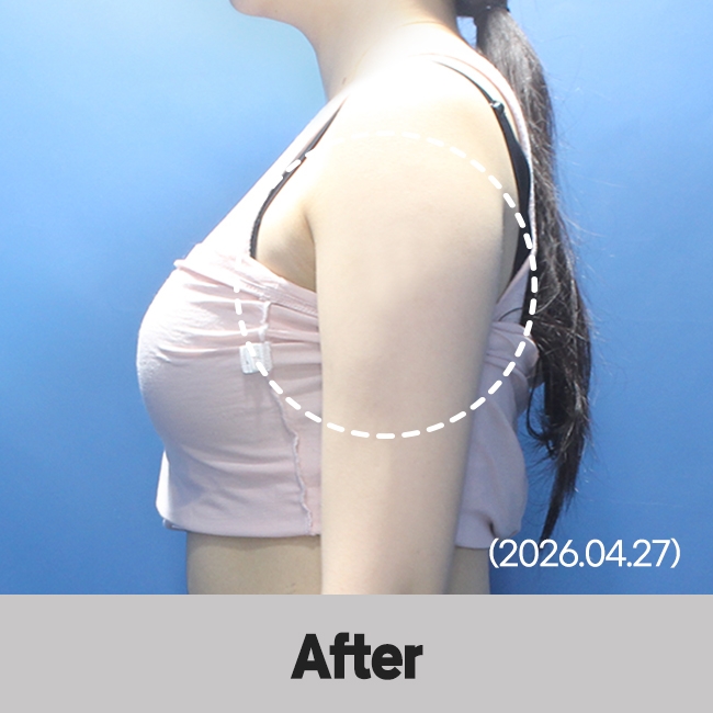 다이어트약+쉬다주사(Body) 시술 후